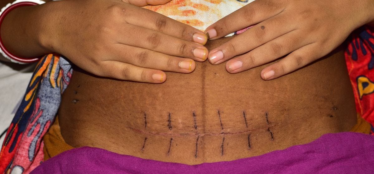 woman showing c section scar